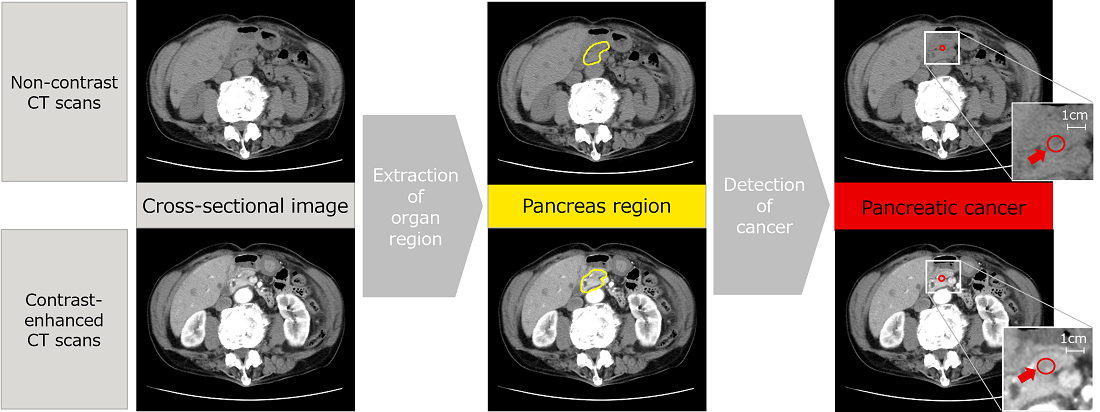 Detection of suspected pancreatic cancer using the newly developed technology